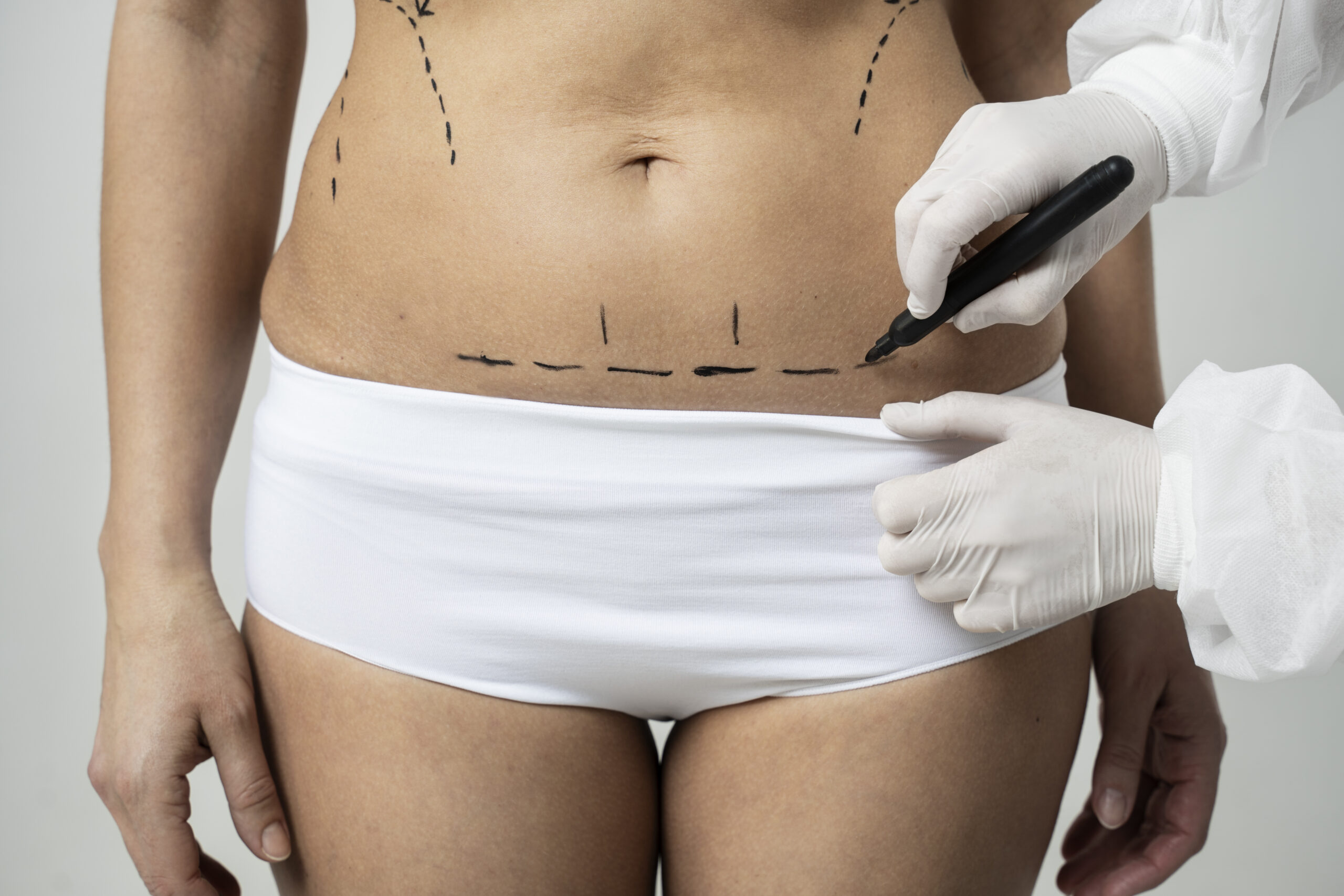 Lipoabdominoplastia